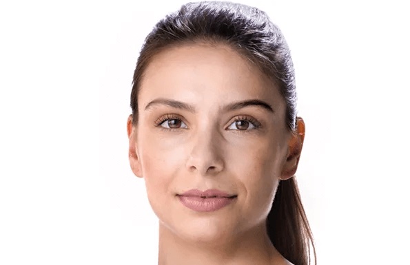 Juvederm Before and After - Case 3, Image 1 - Female, age 25 – 34 - Texas - Lockhart Matter Dermatology & Aesthetic Center
