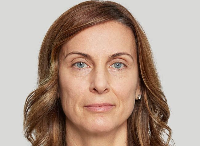 Sculptra Before and After - Case -1, Image 1 - Female, age 45 – 54 - Texas - Lockhart Matter Dermatology & Aesthetic Center