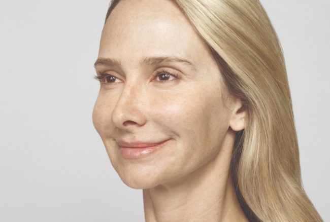 Restylane Before and After - Case 3, Image 2 - N/A, age 45 – 54 - Texas - Lockhart Matter Dermatology & Aesthetic Center