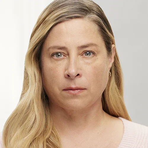 Botox Before and After - Case -1, Image 2 - Female, age 45 – 54 - Texas - Lockhart Matter Dermatology & Aesthetic Center