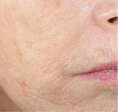 Vivace RF Microneedling Before and After - Case -1, Image 4 - Female, age  - Texas - Lockhart Matter Dermatology & Aesthetic Center