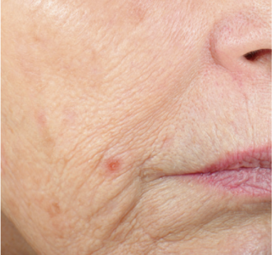 Vivace RF Microneedling Before and After - Case -1, Image 3 - Female, age  - Texas - Lockhart Matter Dermatology & Aesthetic Center